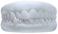 Crooked Teeth