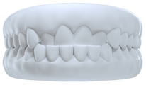 Crossbite