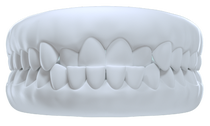 Underbite